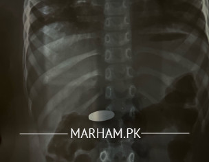 Swallowed Elongated Magnet 
