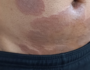 Skin Allergy