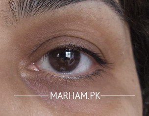 Dark Circles
