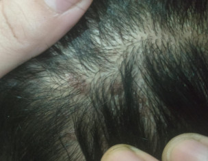 Warts On Head ONLY.