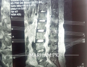 Is It Sciatica?