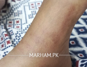 Foot Problem