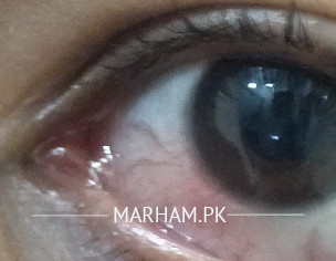 Eye Problem