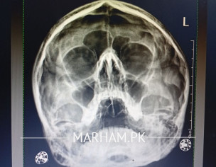 Headache