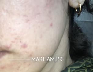 Post Acne 