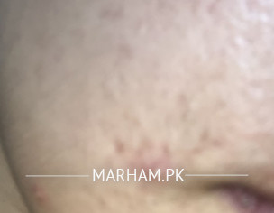 Post Acne 