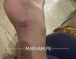 Skin Infection 