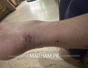 Skin Infection 