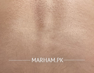 Flaky Dry Back Skin