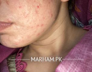 Painfull Acne 