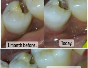 Teeth Issue