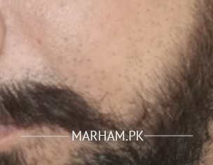 Dark Forehead