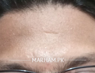 Dark Forehead