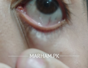 Eye Redness