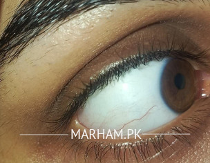 Eye Problem