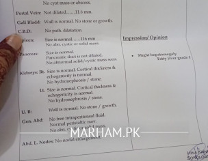Slight Hepatomegaly