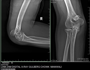 Elbow Surgery
