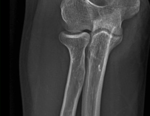Elbow Surgery