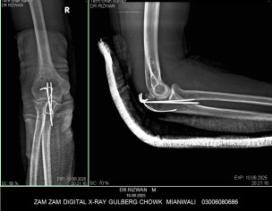 Elbow Surgery