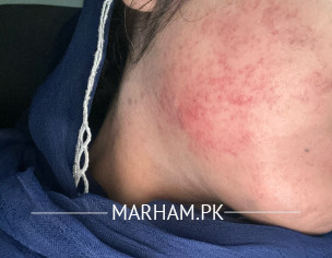 Bruises On Face