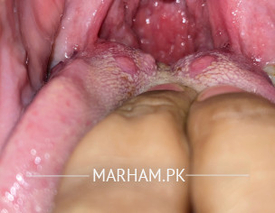 Tonsils, Tongue Ulcers 