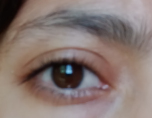 Eye Problem