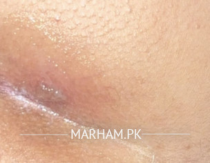 Raised Outbreak On Buttock Line Right Side 