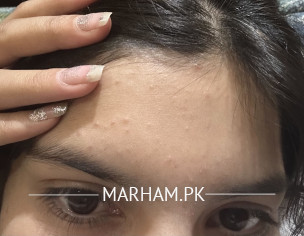 Skin Acne Pimples 