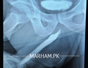 Uretheral Stricture