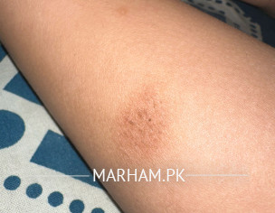 Skin Issue