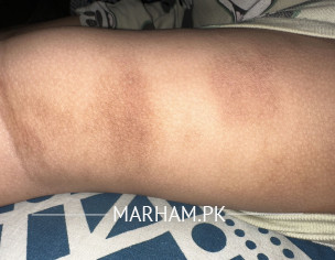 Skin Issue