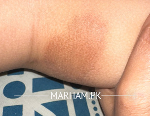 Skin Issue