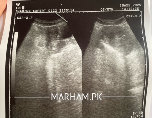 Irregular Periods (spotting)