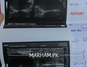 Left Breast Abscess