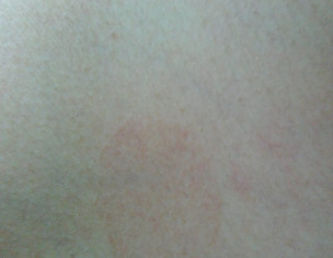 Dark Patch On Skin