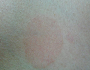 Dark Patch On Skin