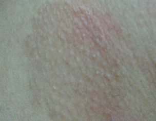 Dark Patch On Skin
