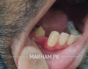 Something On Teeth