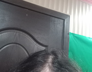 Thinning Hair