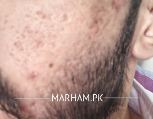 Acne Problem