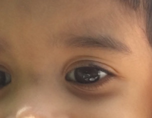 Differet Eyelid