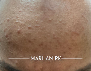 Acne On Forehead 