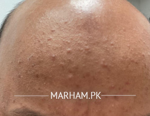 Acne On Forehead 