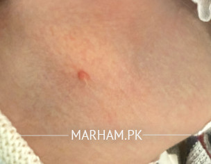 A Bump On Back