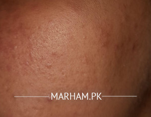 Acne Problems On Mostly Face