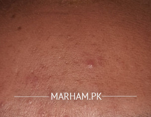 Acne Problems On Mostly Face