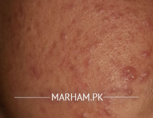 Acne Problems On Mostly Face