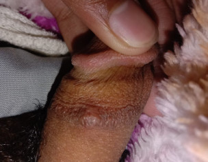 Skin Allergy