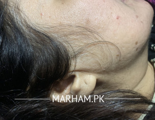 Melasma Treatment 