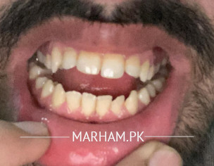 Teeth Open Bite Problem